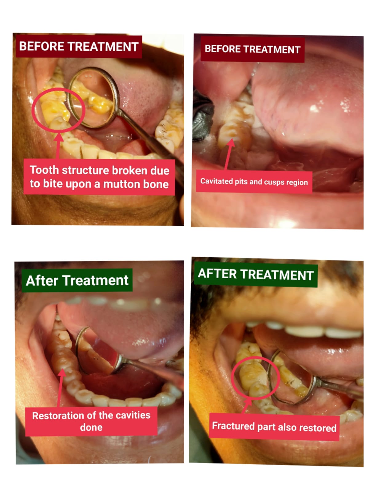 Broken teeth before and after restoration