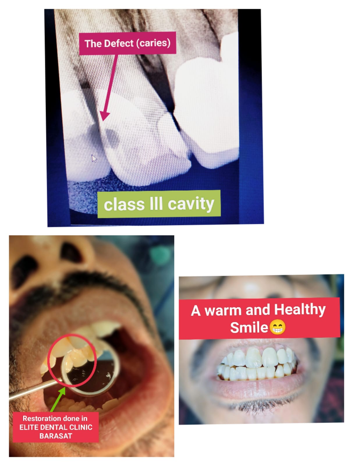 Dental cavity and restoration treatment photographs