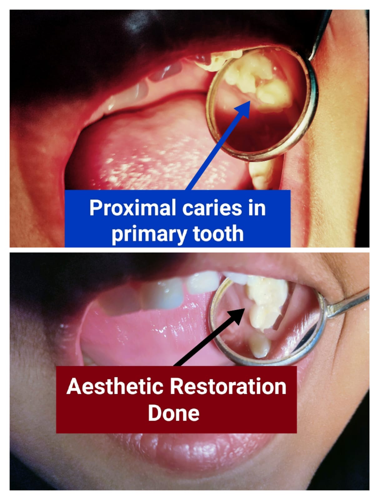 Primary tooth before and after restoration
