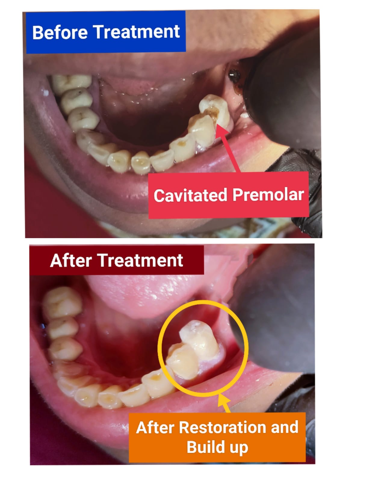 Cavitated premolar before and after restoration and build-up