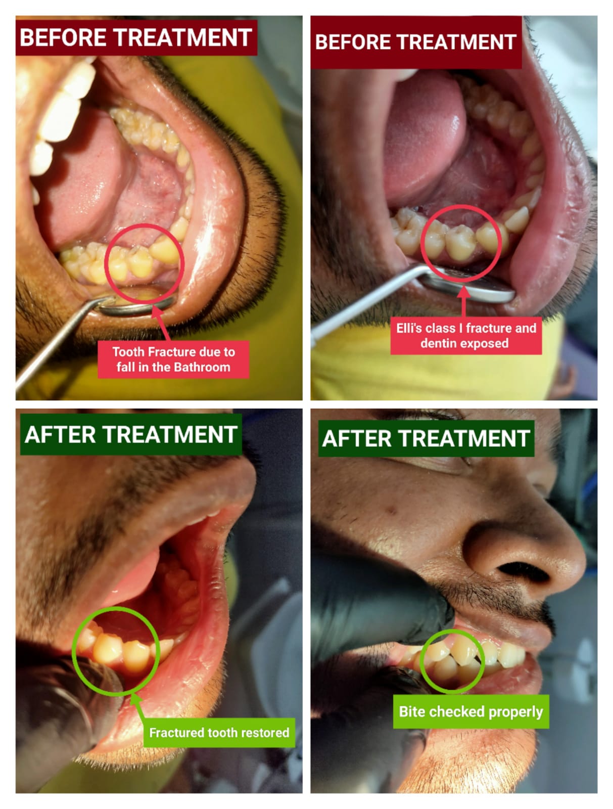 Teeth before and after restorative treatment