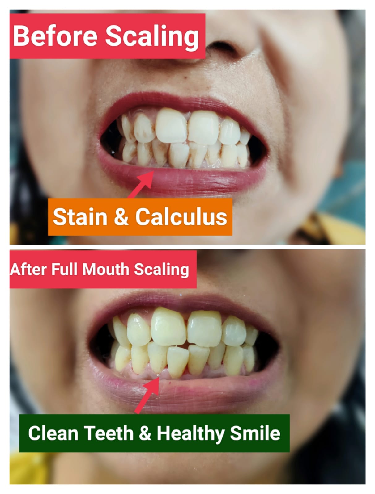 Patient teeth before and after full-mouth scaling