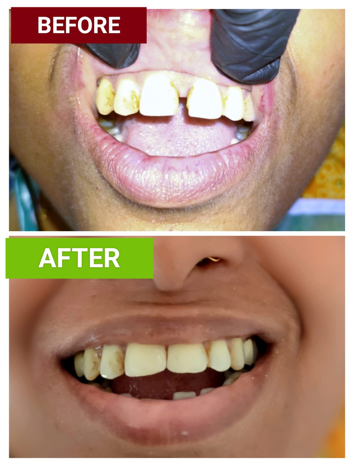 Patient smile before and after dental treatment