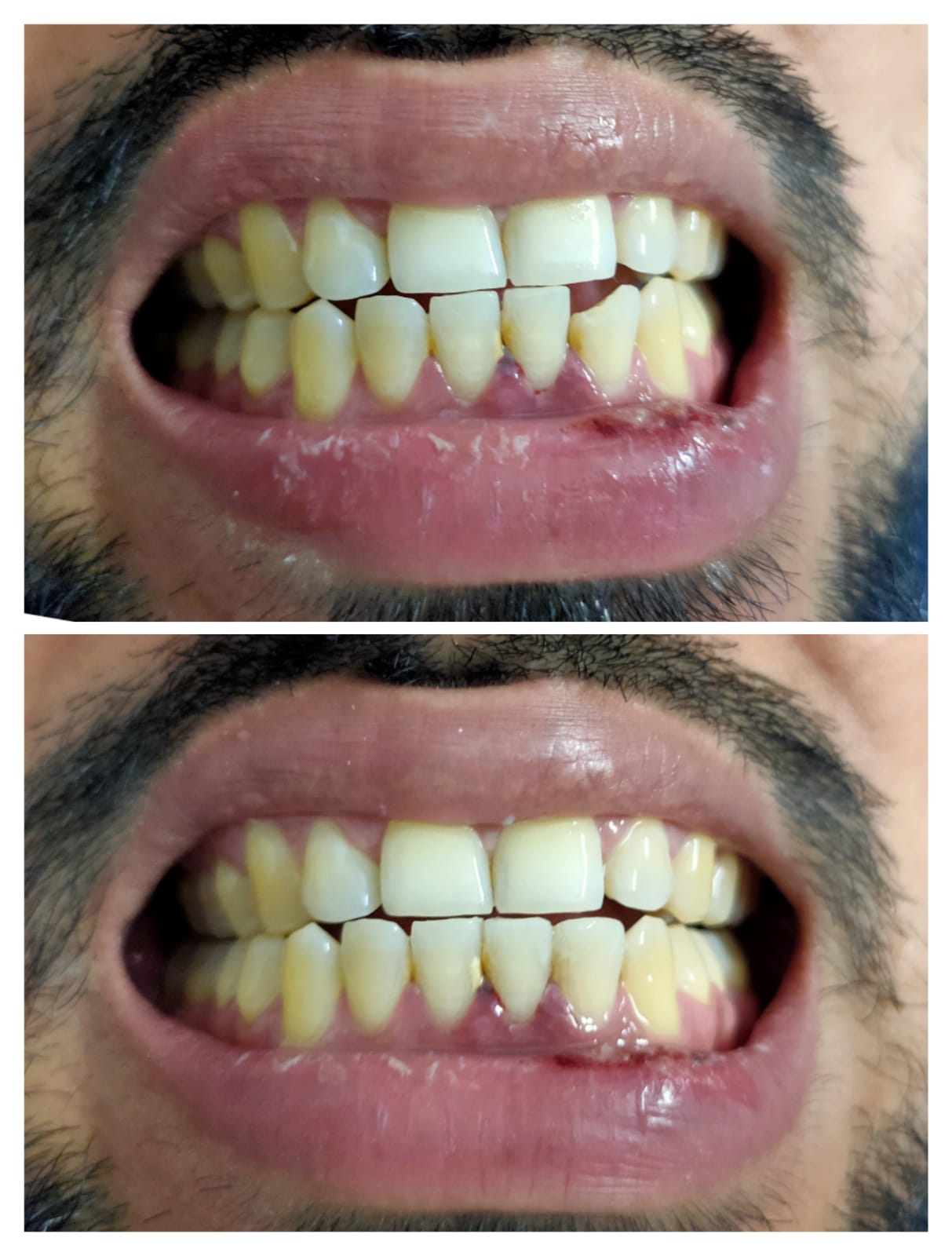 Two photographs comparing a patient's smile